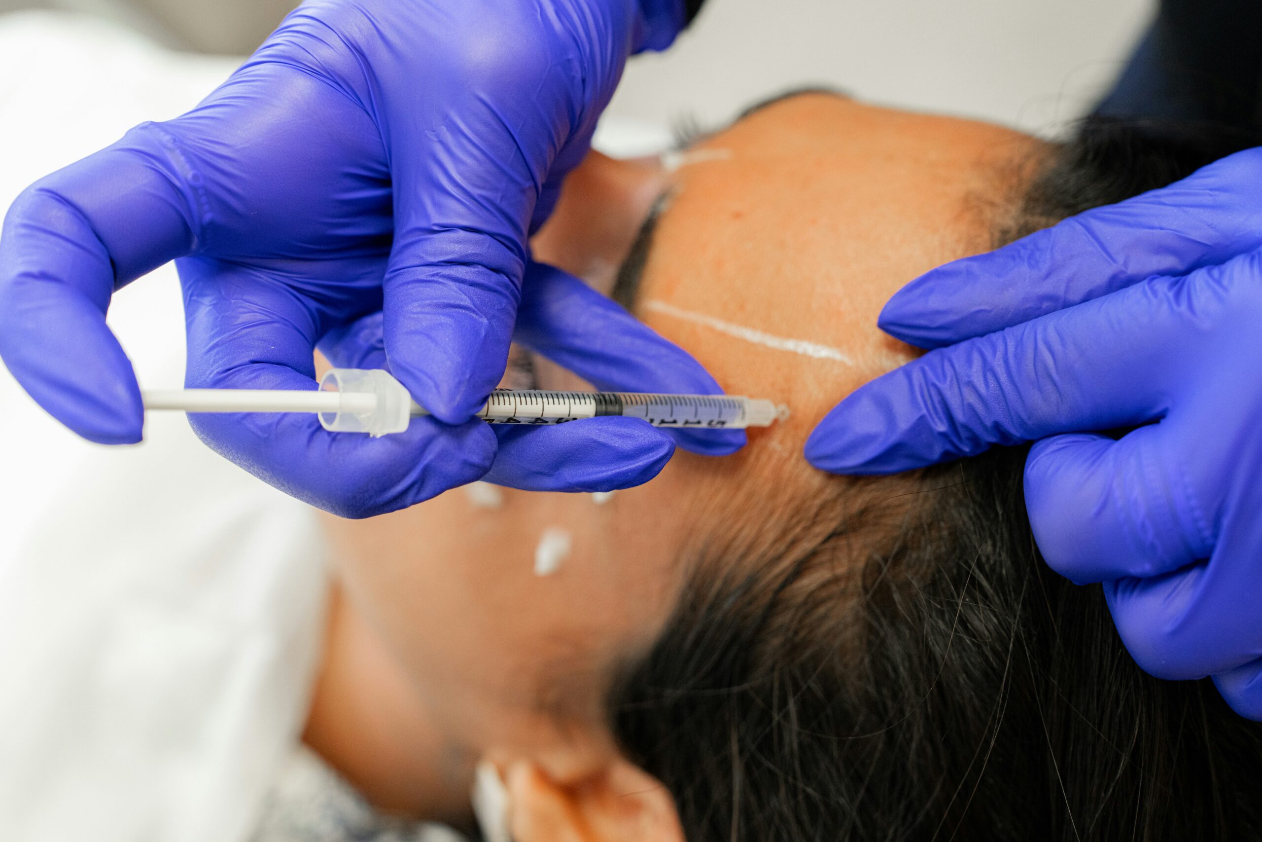 A person with dark hair is lying down while a medical professional wearing blue gloves administers cosmetic injectables using a syringe to the side of their forehead, with white markings visible on their skin.